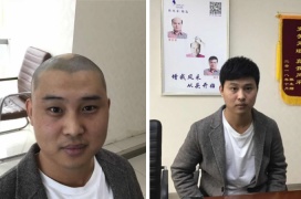 郴州隐形增发补发！28岁小哥头发“怪现象”，一小时挽救人生